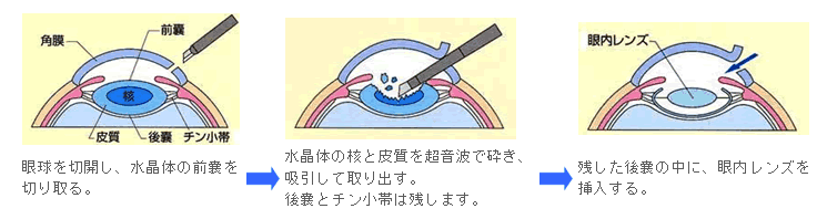 白内障手術
